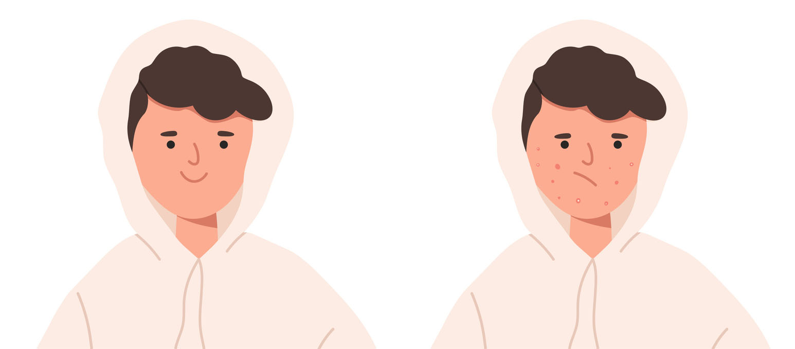 Teenage Boy With Acne Before And After Flat Vector Illustration Isolated On White Background.