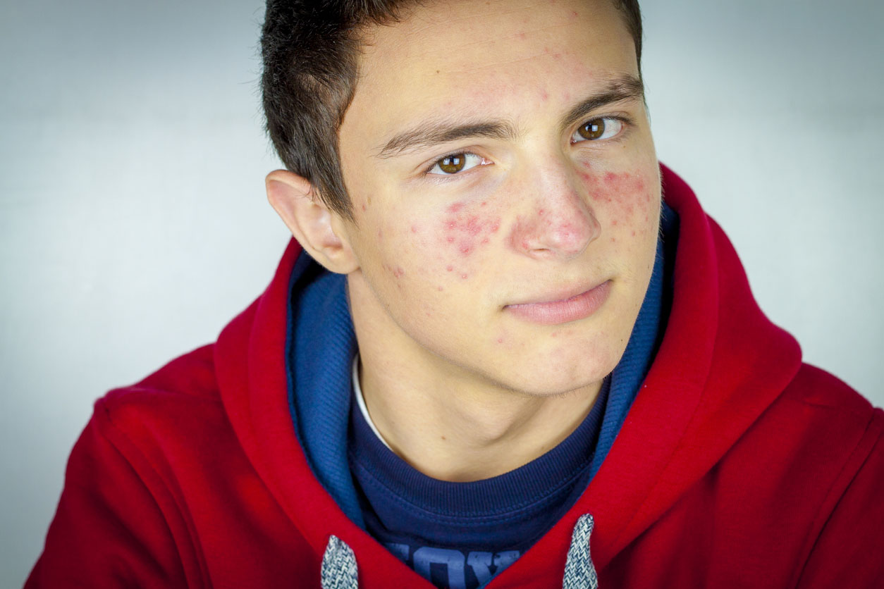 Portrait Of Teenage Boy With Acne