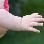 Boutons De Chaleur Sur Le Bras De Bébé